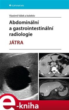 Abdominální a gastrointestinální radiologie - Játra - kolektiv, Vlastimil Válek e-kniha