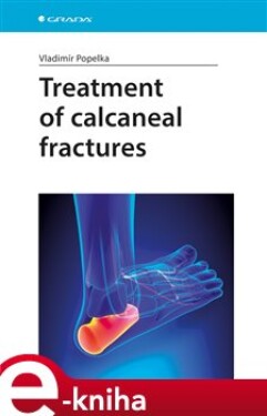 Treatment of calcaneal fractures - Vladimír Popelka e-kniha