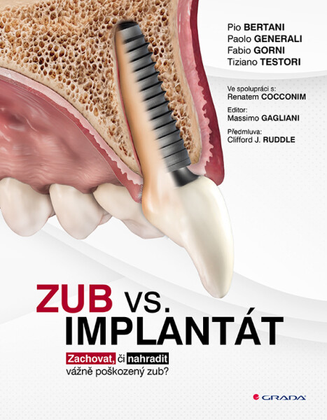 Zub vs. implantát - Zachovat, či nahradit vážně poškozený zub? - kolektiv autorů