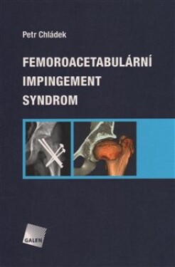 Femoroacetabulární impingement syndrom