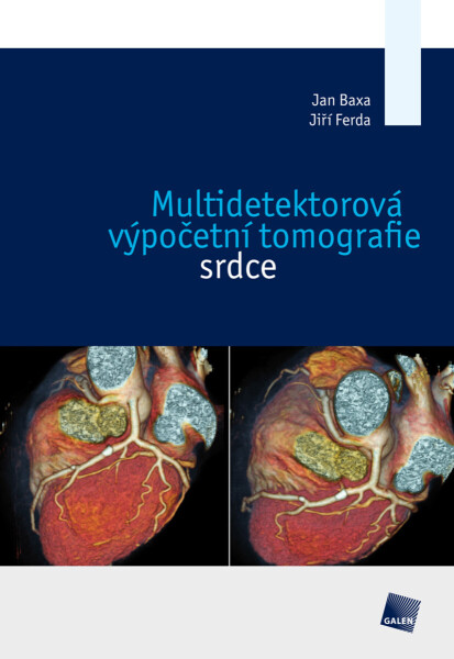 Multidetektorová výpočetní tomografie srdce - Jiří Ferda, Jan Baxa