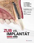 Zub vs. implantát - Zachovat, či nahradit vážně poškozený zub? - kolektiv autorů