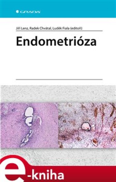 Endometrióza - Jiří Lenz, Radek Chvátal, Luděk Fiala e-kniha