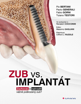 Zub vs. implantát - Zachovat, či nahradit vážně poškozený zub? - kolektiv autorů
